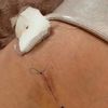 Velká jizva po laserové operaci žil
