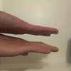 Deformace malíku ruky