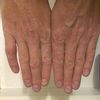 Deformace malíku ruky