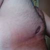 Re-operace odstranění prsou - transsexuál female to male
