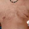 Re-operace odstranění prsou - transsexuál female to male