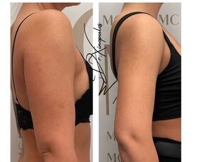 Liposukce paží na MarBelle Clinic