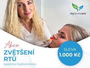 KRÁSNÉ RTY - výplň rtů s kys. hyaluronovou SLEVA 1.000 Kč