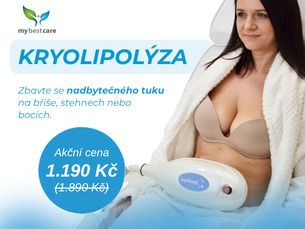 KRYOLYPOLÝZA za 1.190 Kč (původně 1.890 Kč)