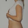 Liposukce stehna-hýždě v lokální anestezii