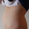 Jsem vhodný typ pro liposukci břicha?