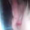 Bolestivý pupínek v záhybu ucha - 12745