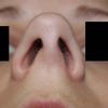 Plastika nosu u alergika se zakřivenou přepážkou - 12754