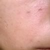 Jizvy a tmavé skvrny na tváři po akné