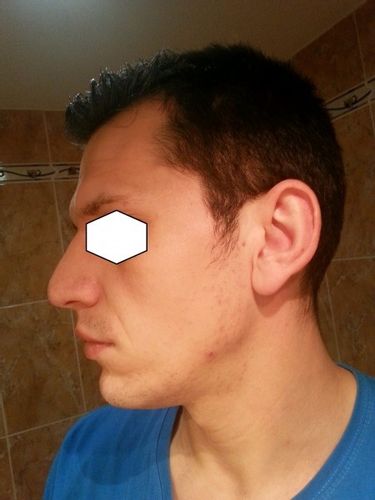 Zmenšení ušních lalůčků