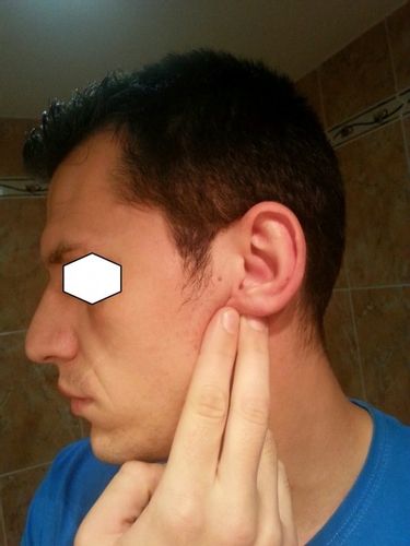 Zmenšení ušních lalůčků
