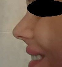 Zúžení a snížení špičky nosu - 12808