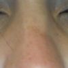 Reoperace nosu - viditelná asimetrie - 12859