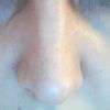 Reoperace nosu - viditelná asimetrie - 12862