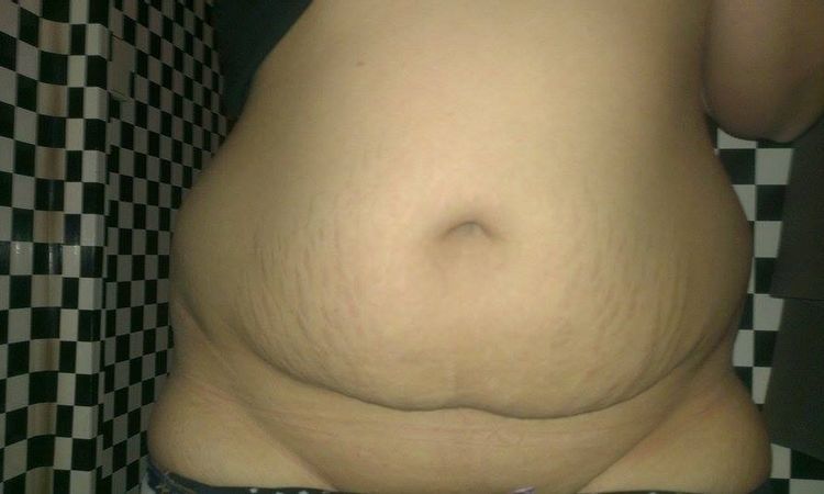 Viditelnost výsledků po liposukci břicha a boků - 12877