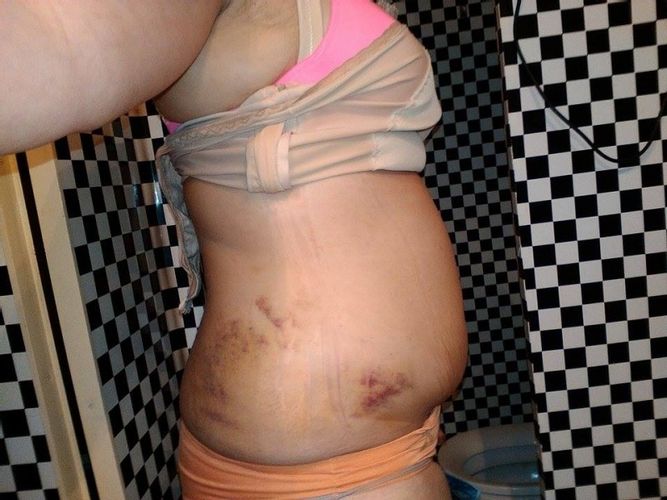 Oprava liposukce břicha a boků