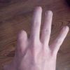 Jak nahradit amputovaný palec na ruce - 12947