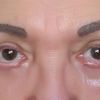 Tukový váček po operaci očních víček - 12960