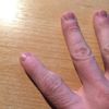 Zvětšený kloub po zlomenině prstu - 12989