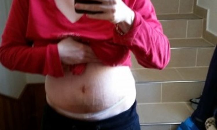 Otok po abdominoplastice? - 12995