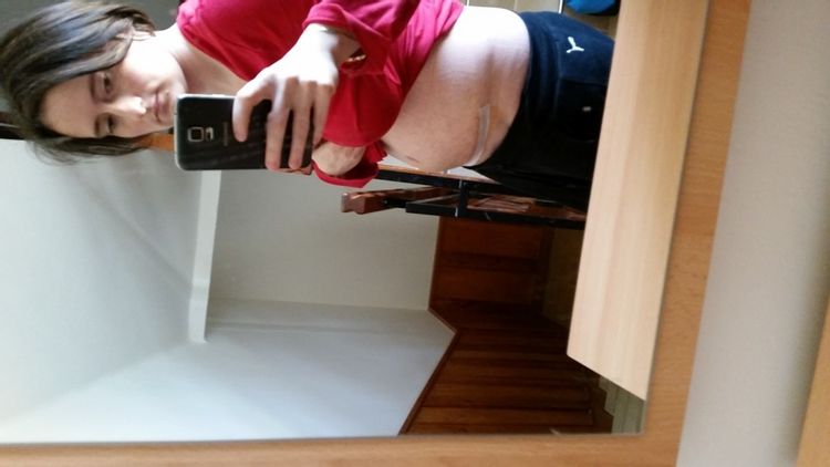 Otok po abdominoplastice?