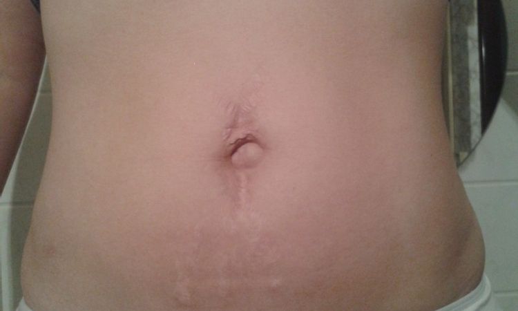 Jizva po piercingu při těhotenství - 13003