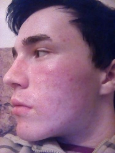 Puchýře a zbělení kůže po chemickém peelingu