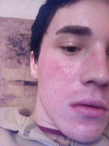 Puchýře a zbělení kůže po chemickém peelingu