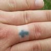 Odstranění tetování z prstu Praha - 13148