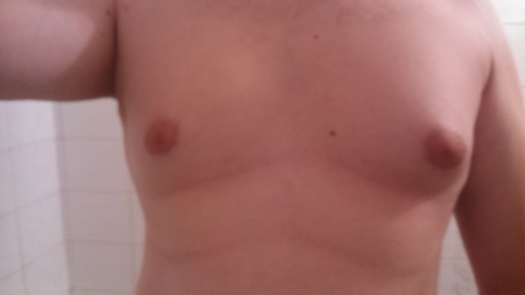 Jedná se o gynekomastii?