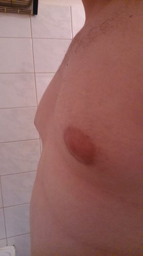 Jedná se o gynekomastii?
