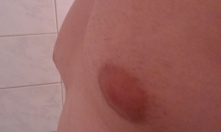 Jedná se o gynekomastii? - 13166