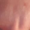 Botox ani kyselina hya mi na vrásky nezabírají - co dál?