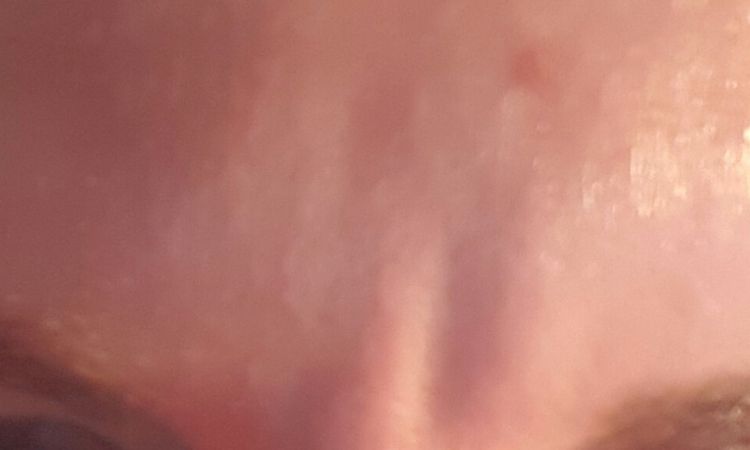 Botox ani kyselina hya mi na vrásky nezabírají - co dál? - 13177