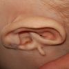 Odstranění kožního výrůstku u ucha miminko - 13187