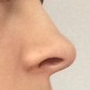 Zjemnění nosu/ Rhinoplastika - 13268