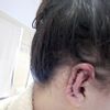 Bolest a horké ucho po otoplastice - 13275