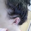 Bolest a horké ucho po otoplastice - 13276