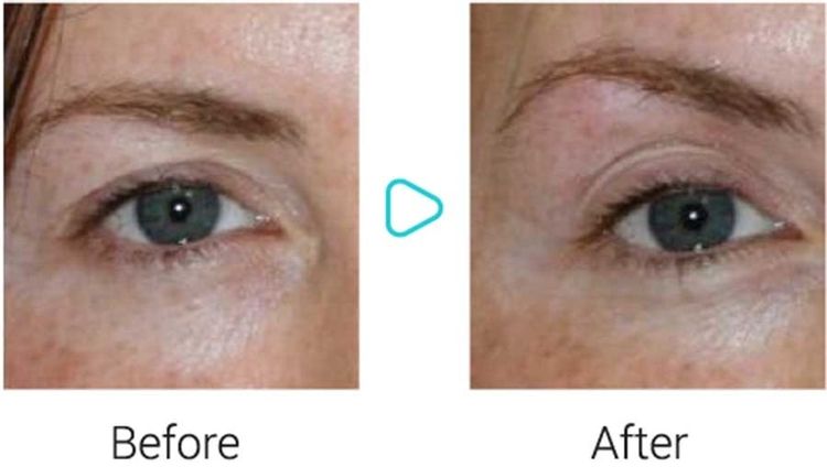 Temporal/ lateral brow lift