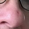 Atrofická jizva na nose - 13319