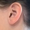 Asymetrie tvaru uší