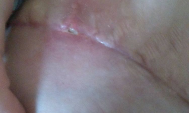 Hojení jizvy po abdominoplastice - 13359