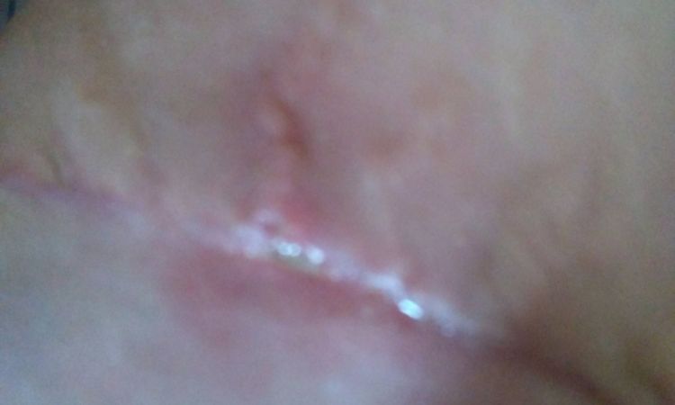 Hojení jizvy po abdominoplastice - 13360