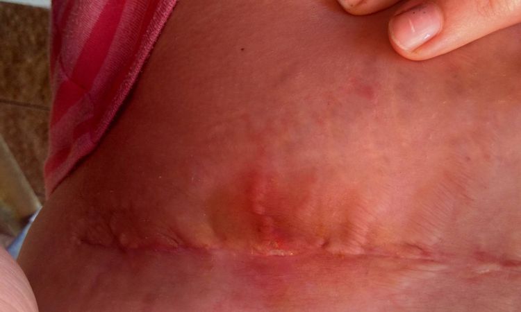 Hojení jizvy po abdominoplastice - 13361