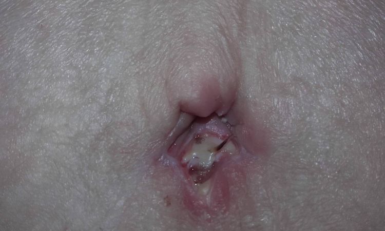 Hojení pupku po abdominoplastice - 13394
