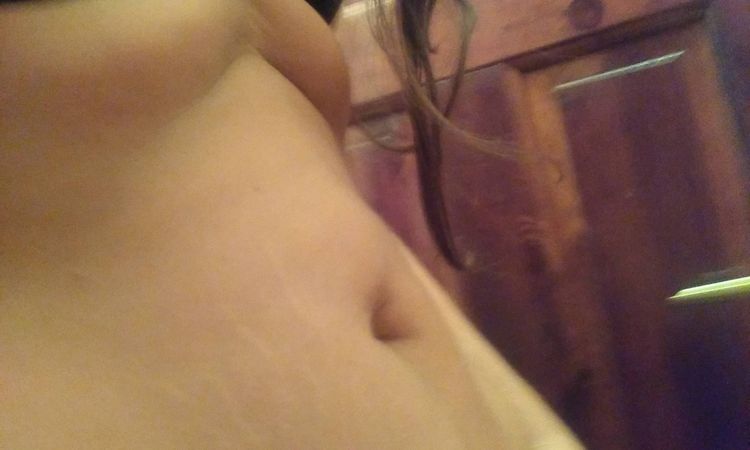 Miniabdominoplastika - 13399