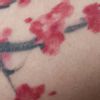 Odstranění čerstvého barevného tetování - 13404