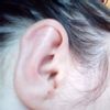 Divně přirostlé ucho po otoplastice - 13448