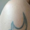 Odstranění tetování - 20 let staré - 13478