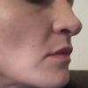 Zjemnění nosu, odstranění špičky a hrbolu - 13491